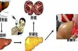 肝硬化治疗方法,肝硬化综合治疗策略与最新进展